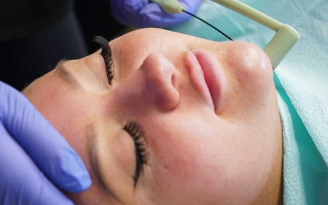 FaceTite : La Révolution du Rajeunissement Facial Sans Chirurgie Lourde