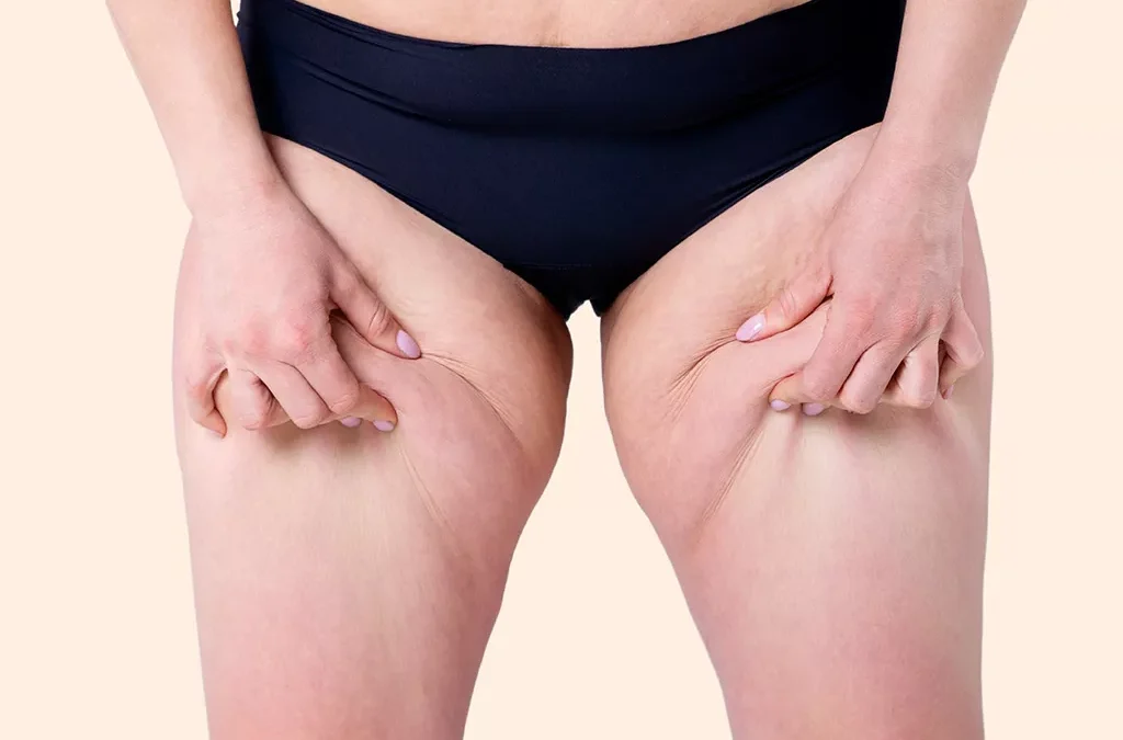 Douleurs, jambes lourdes, ecchymoses : et si c’était un lipœdème ? Quelles solutions ?
