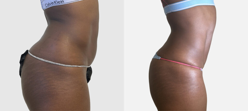 Liposuccion 4D : la révolution du body contouring haute définition avec le Dr Gam