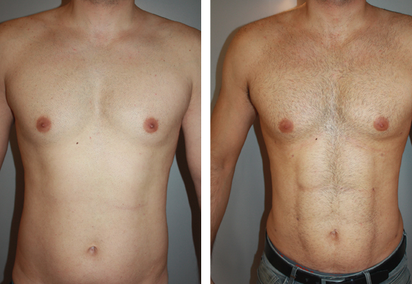 U-Graft : la technique avancée pour sculpter des abdos naturels et athlétiques en Tunisie