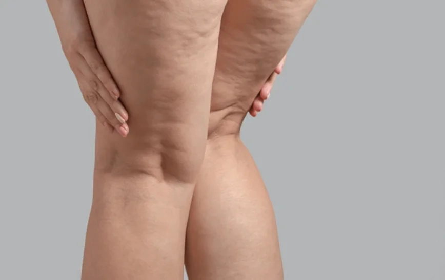 Pourquoi les régimes ne fonctionnent pas en cas de lipœdème ?