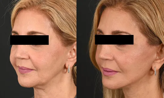 Deep Plane Facelift en Tunisie : lifting nouvelle génération pour un rajeunissement naturel, Dr Gam