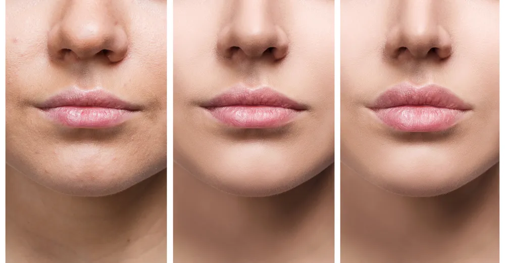 4 types de chirurgie du nez