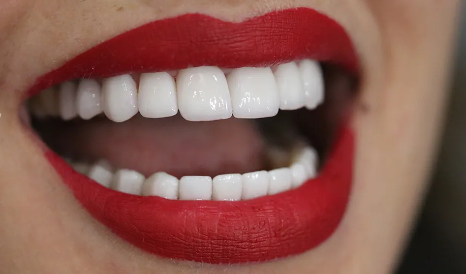 Comprendre le Hollywood Smile